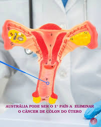 Austrália caminha para eliminar o câncer de colo do útero; Brasil intensifica avanço